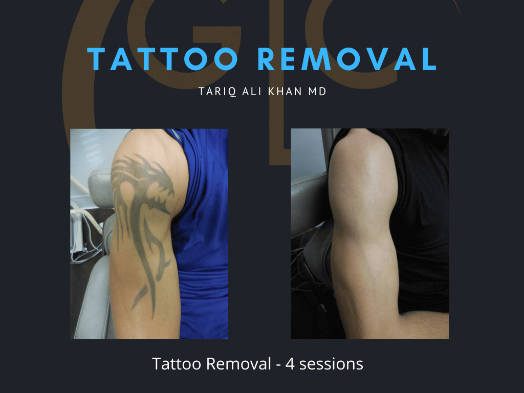 Gentle Care Laser Tustin & Long Beach CA Before and After picture - Tattoo Removal